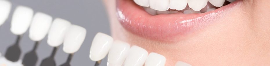 how-to-prevent-veneers-from-breaking