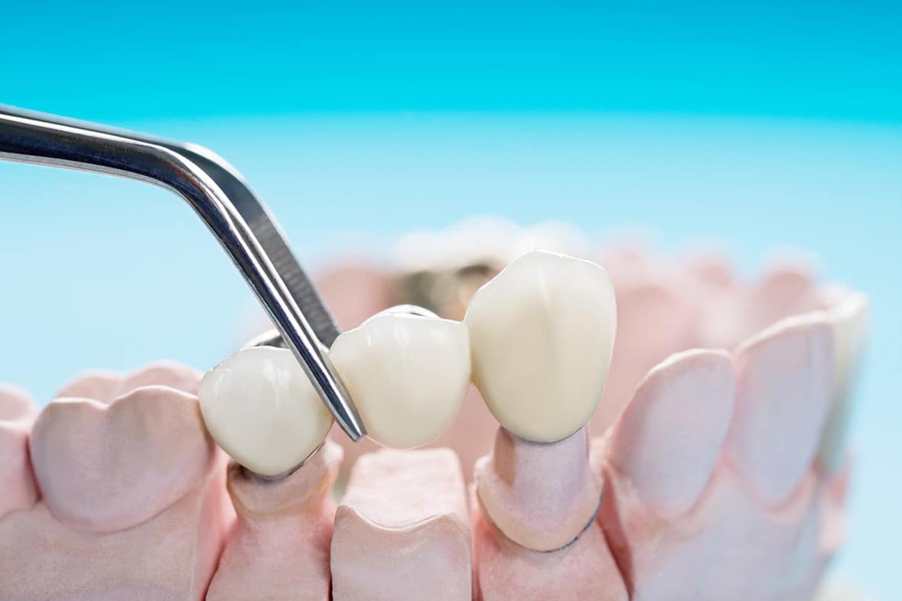 How Long Does It Take For a Dental Bridge To Feel Normal?