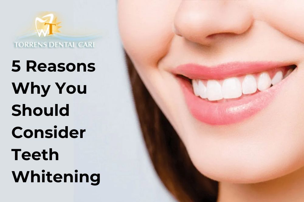 5 Reasons Why You Should Consider Teeth Whitening