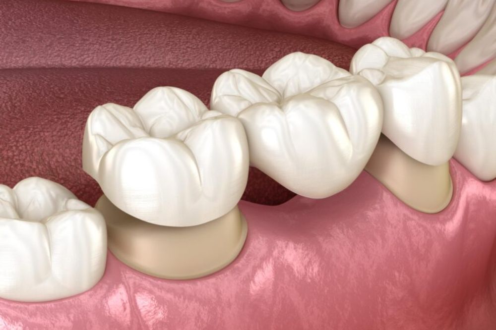 What is The Importance of Dental Bridge