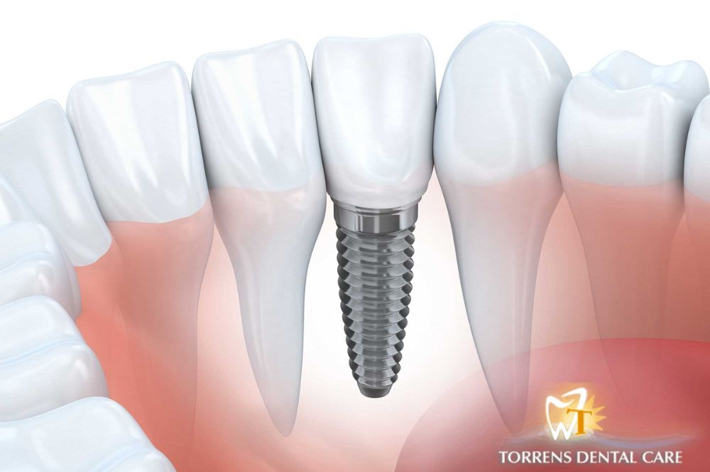 Are-Dental-Implants-Safe